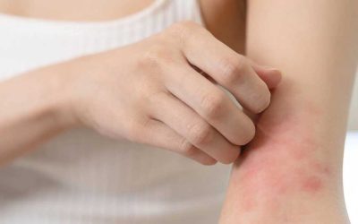 Dermatitis atópica: conociendo y controlando la piel sensible